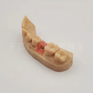 dental model partial arch